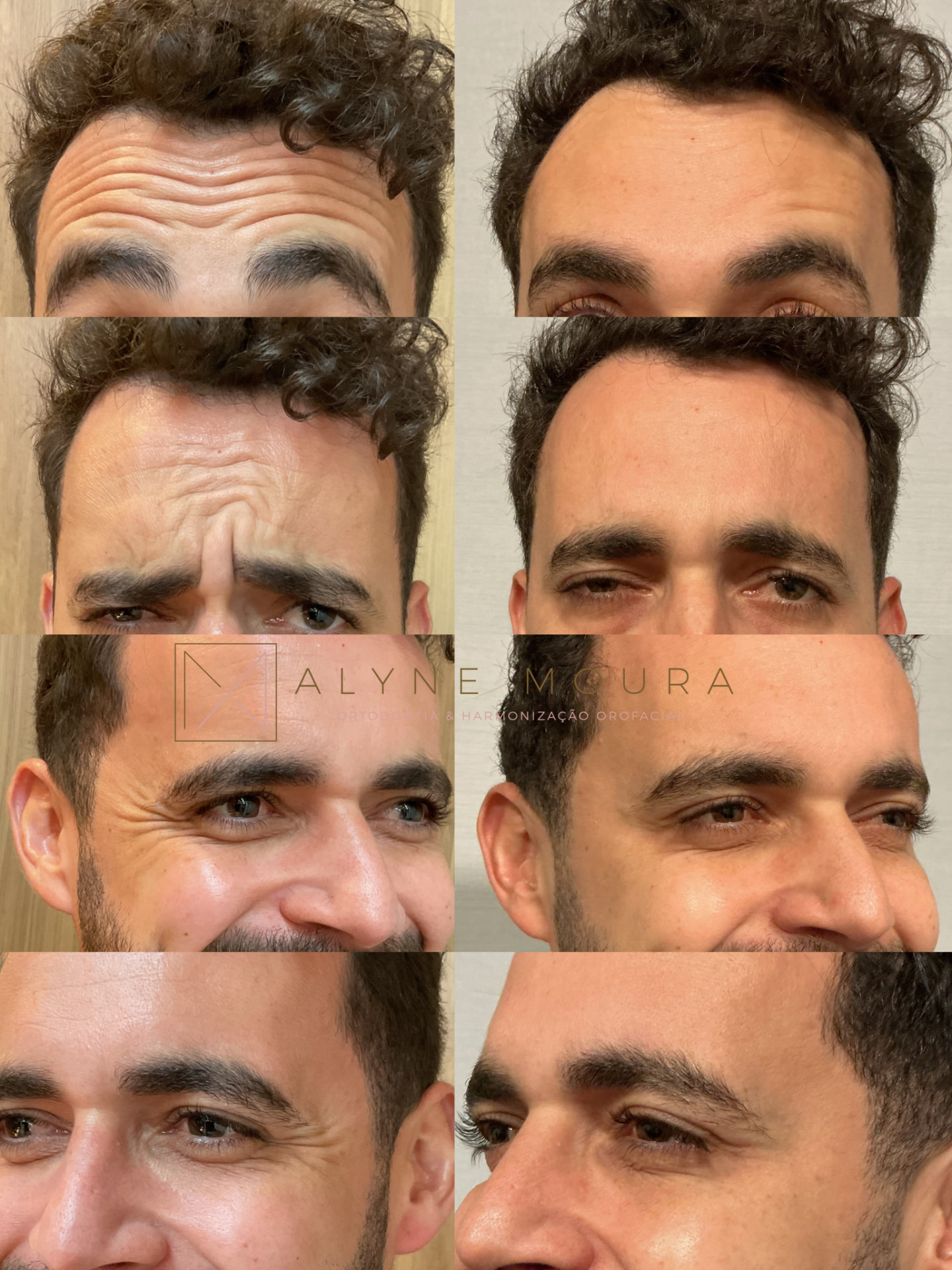Antes e depois da toxina botulínica: suavização de rugas de testa, glabela e pés de galinha — Dra. Alyne Moura, Recife